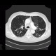 Panlobular emphysema, vanishing lung syndrome, bullous emphysema: CT - Computed tomography